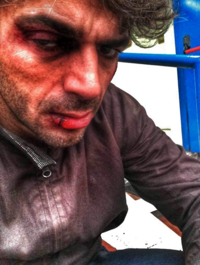 Luca Argentero posta un selfie su Facebook con il volto tumefatto
