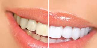 Benessere e Salute: Denti Macchiati? Cause e rimedi Denti Macchiati,